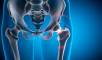 Hip Fractures