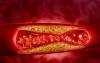 Atherosclerosis