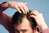 Hair Loss