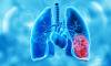 Lung Cancer