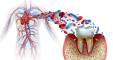 Gum Disease